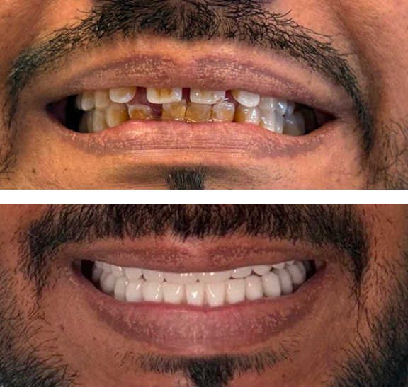 smile before after