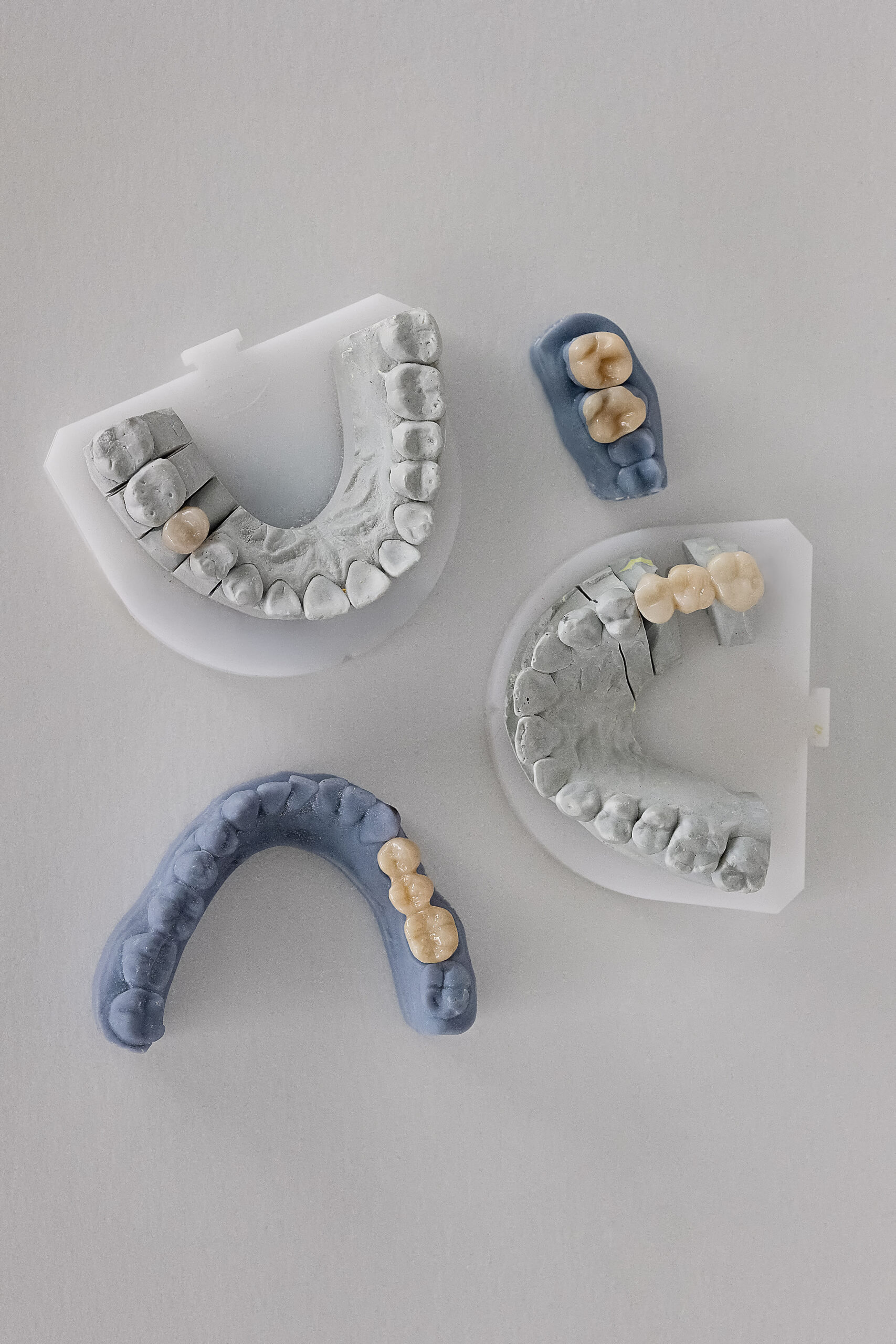 Gypsum and plastic dental molds with fixed prosthetics: crowns, bridges, and inlays. Demonstration of restorative techniques in modern dentistry on white background.