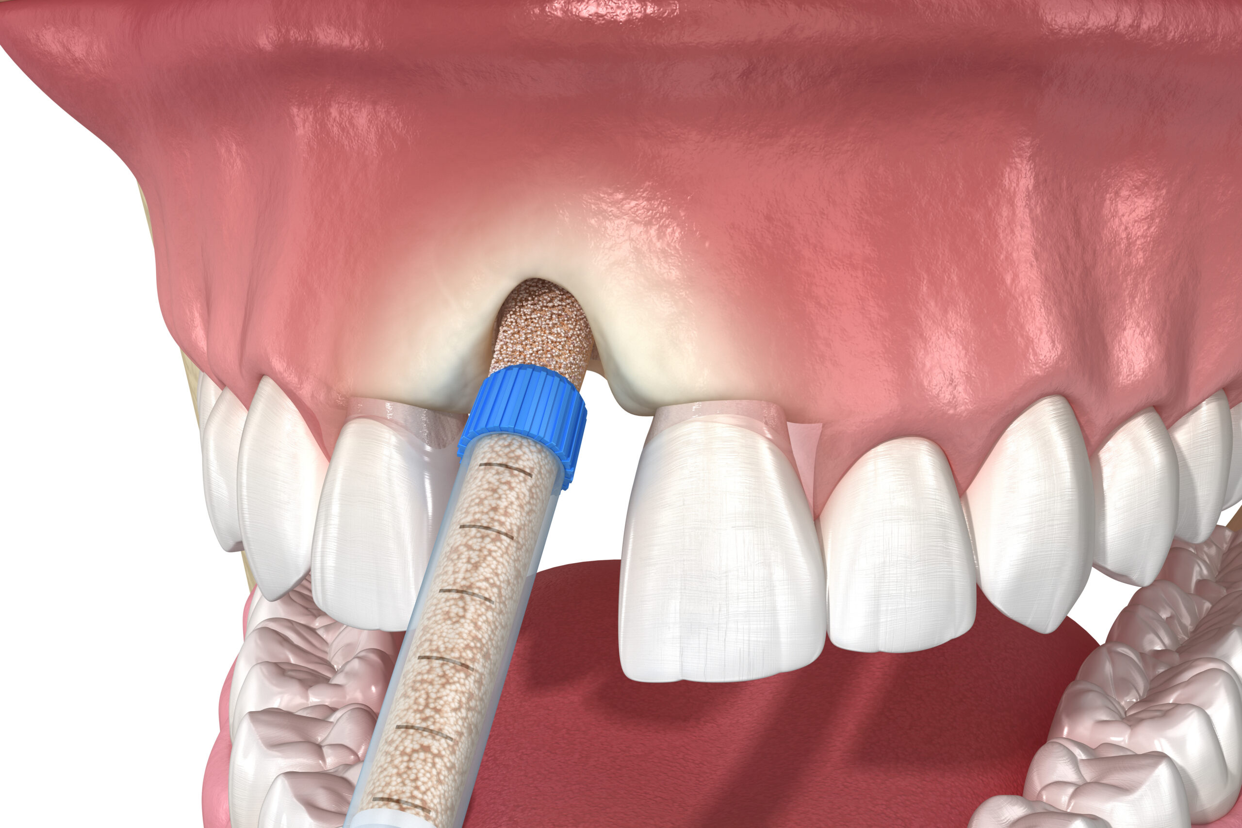 Bone grafting augmentation, socket preservation, tooth implantation. Medically accurate 3D illustration.